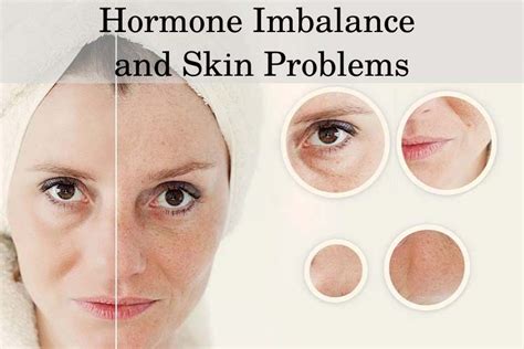 How To Cope With Skin Issues Related To Hormones?